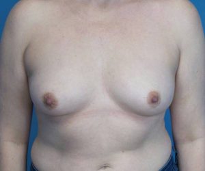 before breast lift with augmentation front view case 3250 | Crispin Plastic Surgery Atlanta, GA