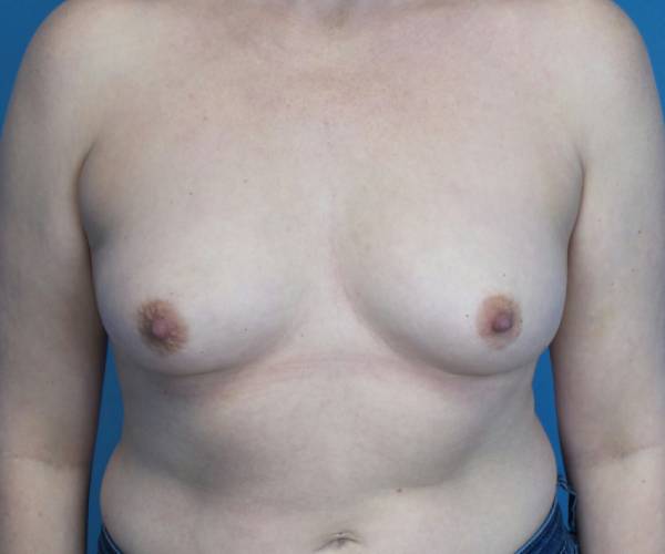 before breast lift with augmentation front view case 3250 | Crispin Plastic Surgery Atlanta, GA