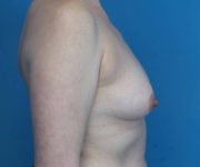 before breast lift with augmentation right side view case 3250 | Crispin Plastic Surgery Atlanta, GA