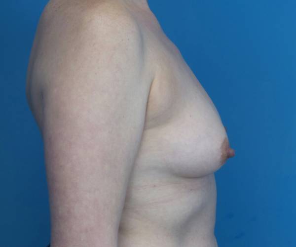 before breast lift with augmentation right side view case 3250 | Crispin Plastic Surgery Atlanta, GA