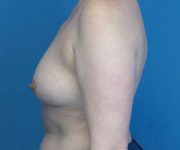 before breast lift with augmentation left side view case 3250 | Crispin Plastic Surgery Atlanta, GA
