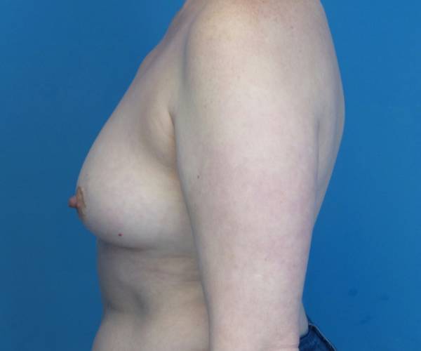 before breast lift with augmentation left side view case 3250 | Crispin Plastic Surgery Atlanta, GA
