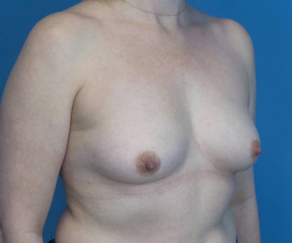 before breast lift with augmentation front right diagonal view case 3250 | Crispin Plastic Surgery Atlanta, GA