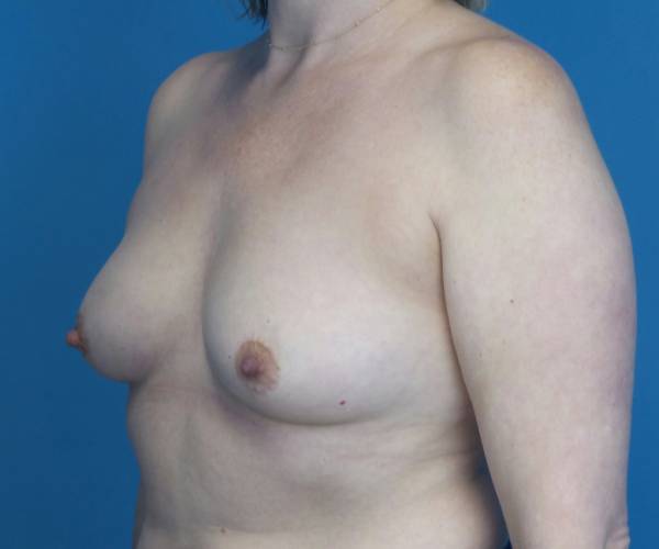 before breast lift with augmentation front left diagonal view case 3250 | Crispin Plastic Surgery Atlanta, GA