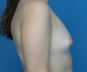 before breast lift with augmentation right side view case 3241 | Crispin Plastic Surgery Atlanta, GA