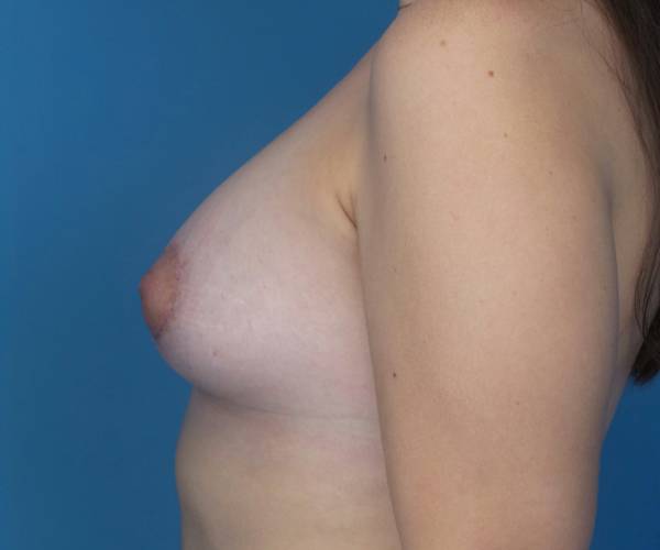 after breast lift with augmentation left side view case 3241 | Crispin Plastic Surgery Atlanta, GA
