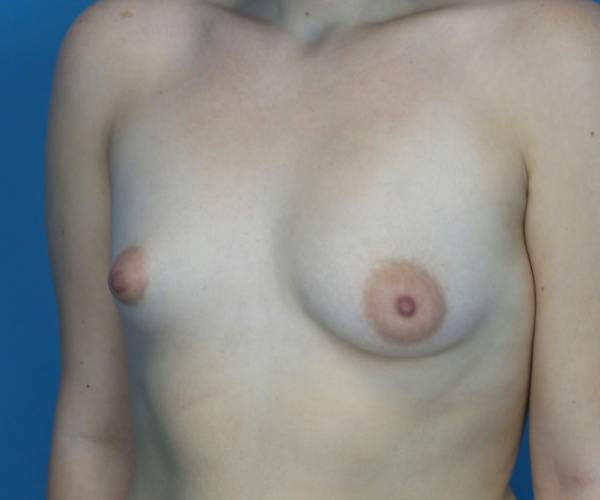 before breast lift with augmentation front left diagonal view case 3241 | Crispin Plastic Surgery Atlanta, GA
