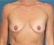 before breast lift with augmentation front view case 3283 | Crispin Plastic Surgery Atlanta, GA
