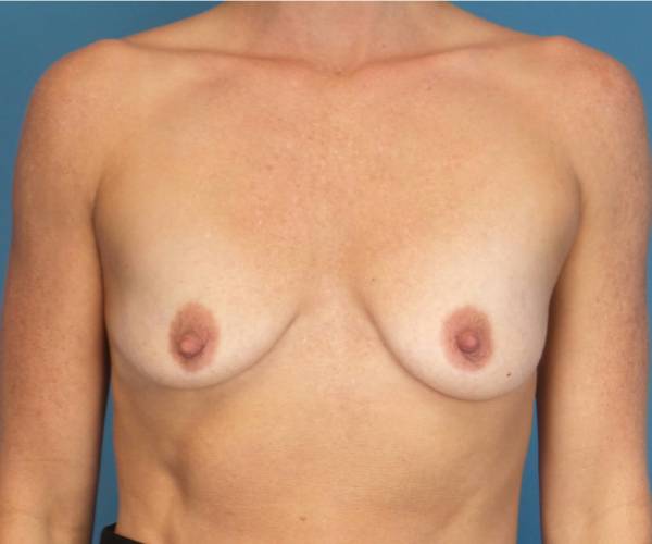 before breast lift with augmentation front view case 3283 | Crispin Plastic Surgery Atlanta, GA