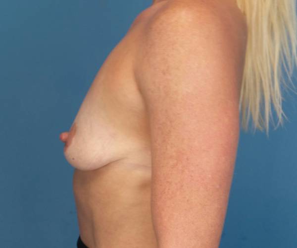 before breast lift with augmentation left side view case 3283 | Crispin Plastic Surgery Atlanta, GA