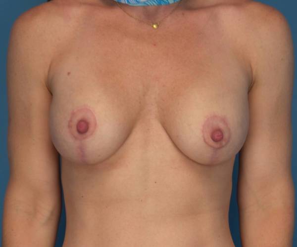 after breast lift with augmentation front view case 3261 | Crispin Plastic Surgery Atlanta, GA