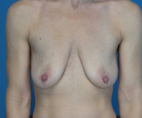 before breast lift with augmentation front view case 3261 | Crispin Plastic Surgery Atlanta, GA