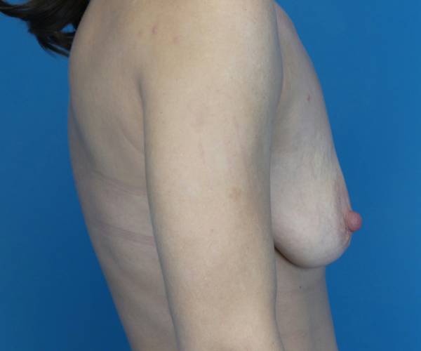 before breast lift with augmentation right side view case 3261 | Crispin Plastic Surgery Atlanta, GA