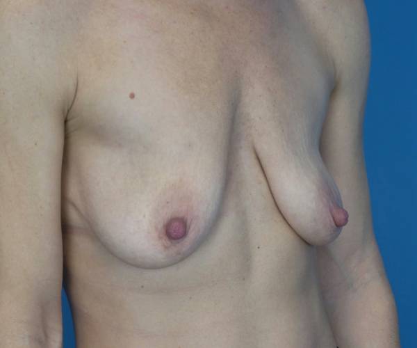 before breast lift with augmentation front right diagonal view case 3261 | Crispin Plastic Surgery Atlanta, GA