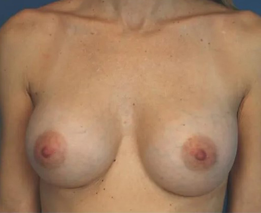 after breast augmentation front view case 4585 | Crispin Plastic Surgery Atlanta, GA