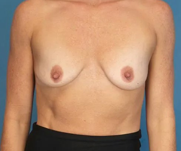 before breast augmentation front view case 4657 | Crispin Plastic Surgery Atlanta, GA