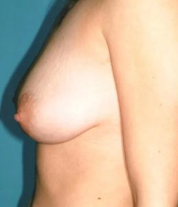 before breast lift with augmentation left side view case 4722 | Crispin Plastic Surgery Atlanta, GA