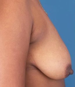 before breast lift with augmentation right side view case 4725 | Crispin Plastic Surgery Atlanta, GA