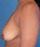 before breast lift with augmentation left side view case 4725 | Crispin Plastic Surgery Atlanta, GA