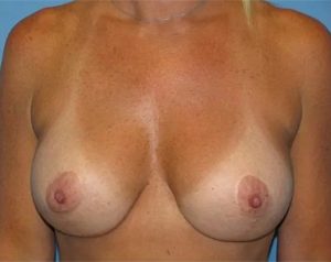 after breast lift with augmentation front view case 4730 | Crispin Plastic Surgery Atlanta, GA