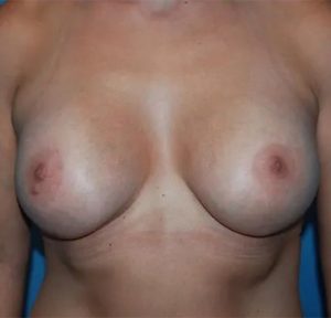 after breast lift with augmentation front view case 4736 | Crispin Plastic Surgery Atlanta, GA