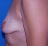 before breast lift with augmentation left side view case 4736 | Crispin Plastic Surgery Atlanta, GA