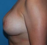 after breast lift with augmentation left side view case 4736 | Crispin Plastic Surgery Atlanta, GA