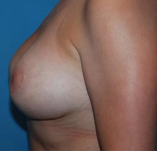 after breast lift with augmentation left side view case 4736 | Crispin Plastic Surgery Atlanta, GA
