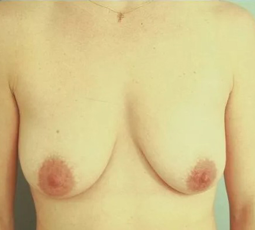 before breast lift with augmentation front view case 4743 | Crispin Plastic Surgery Atlanta, GA