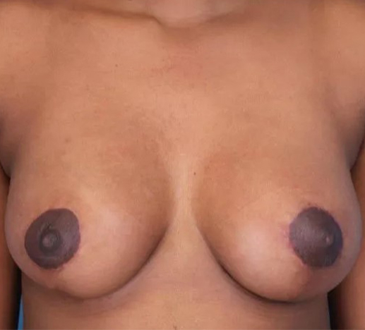 after breast lift with augmentation front view case 4746 | Crispin Plastic Surgery Atlanta, GA