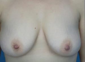 before breast lift with augmentation front view case 4749 | Crispin Plastic Surgery Atlanta, GA