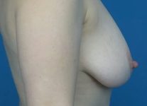 before breast lift with augmentation right side view case 4749 | Crispin Plastic Surgery Atlanta, GA