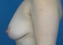 before breast lift with augmentation left side view case 4749 | Crispin Plastic Surgery Atlanta, GA