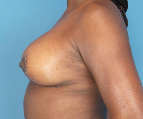after breast lift with augmentation left side view case 4761 | Crispin Plastic Surgery Atlanta, GA