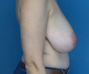 Before Breast Reduction Female Patient Right Side Angle View Case 2118