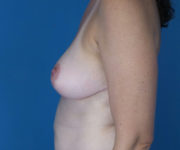 After Breast Reduction Female Patient Left Side Angle View Case 2118