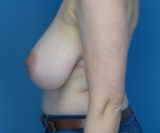 Before Breast Reduction Female Patient Left Side Angle View Case 2118