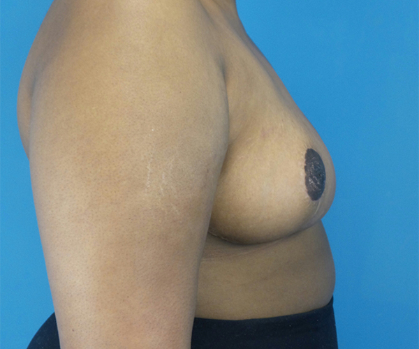 After Breast Reduction Female Patient Right Side Angle View Case 2128