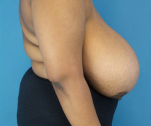 Before Breast Reduction Female Patient Right Side Angle View Case 2128