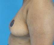 After Breast Reduction Female Patient Left Side Angle View Case 2128