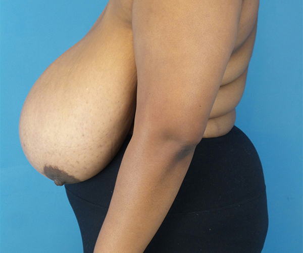 Before Breast Reduction Female Patient Left Side Angle View Case 2128