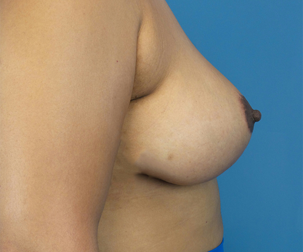 after breast reduction right side view case 2134
