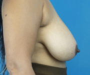 before breast reduction right side view case 2134 | Crispin Plastic Surgery