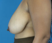 before breast reduction left side view case 2134 | Crispin Plastic Surgery