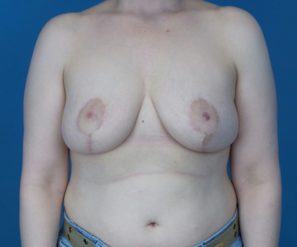 after breast reduction front view case 2708
