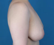 before breast reduction right side view case 2708
