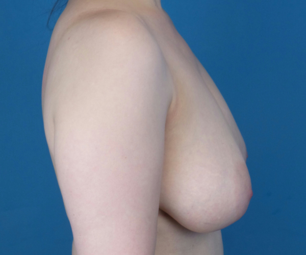 before breast reduction right side view case 2708