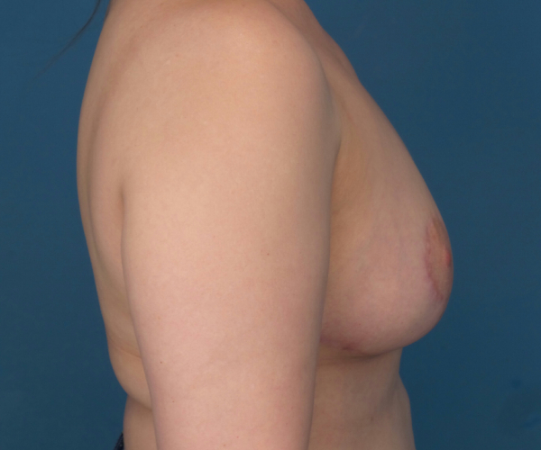 after breast reduction right side view case 2708