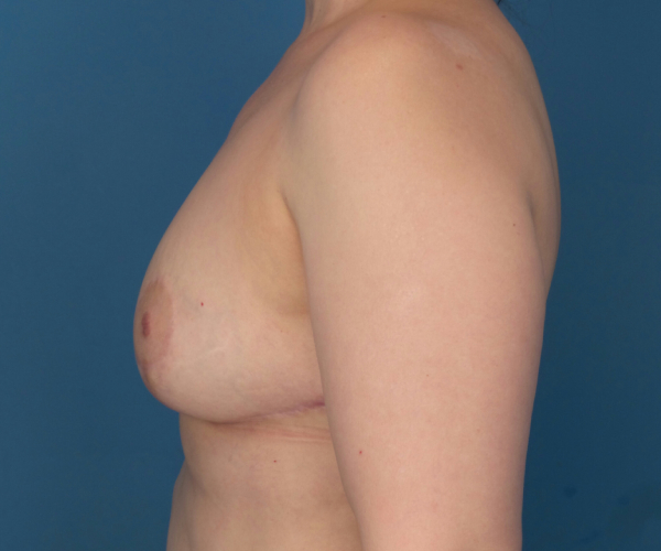 after breast reduction left side view case 2708