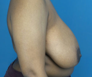 before breast reduction right side view case 2715
